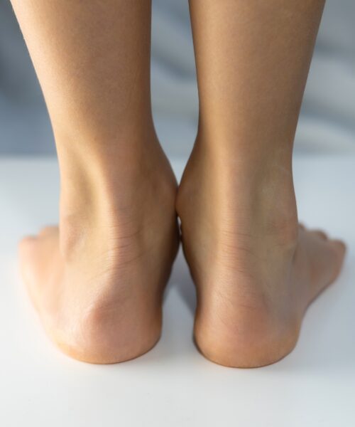 nedsunken-forfod-saadan-faar-du-stoette-i-hverdagen